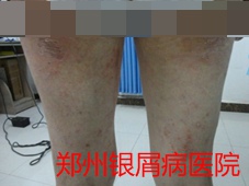 郑州牛皮癣医院治疗牛皮癣图片