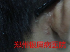郑州牛皮癣医院治疗牛皮癣图片