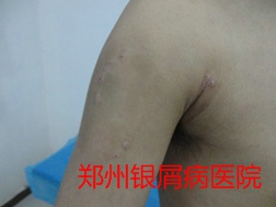 郑州牛皮癣医院治疗牛皮癣图片