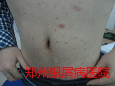 郑州牛皮癣医院治疗牛皮癣图片