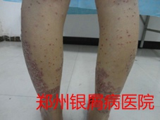 郑州牛皮癣医院治疗牛皮癣图片