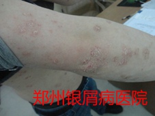 郑州牛皮癣医院治疗牛皮癣图片