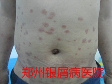 郑州牛皮癣医院治疗牛皮癣图片