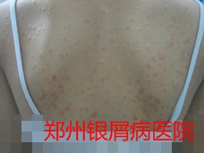 郑州牛皮癣医院治疗牛皮癣图片