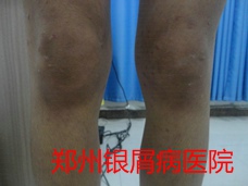 郑州牛皮癣医院治疗牛皮癣图片