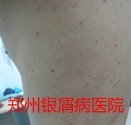 郑州牛皮癣医院治疗牛皮癣图片