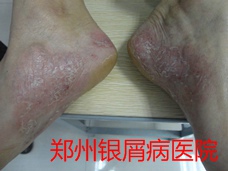 郑州牛皮癣医院治疗牛皮癣图片