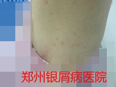 郑州牛皮癣医院治疗牛皮癣图片