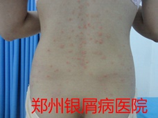 郑州牛皮癣医院治疗牛皮癣图片