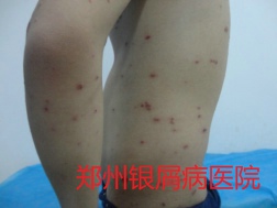 郑州牛皮癣医院治疗牛皮癣图片
