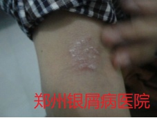 郑州牛皮癣医院治疗牛皮癣图片