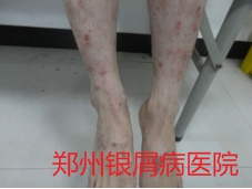 郑州牛皮癣医院治疗牛皮癣图片