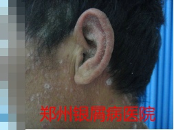 郑州牛皮癣医院治疗牛皮癣图片