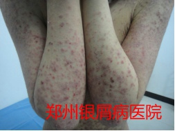 郑州牛皮癣医院治疗牛皮癣图片