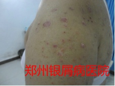 郑州牛皮癣医院治疗牛皮癣图片