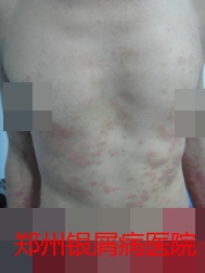 郑州牛皮癣医院治疗牛皮癣图片