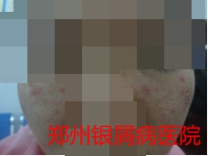 郑州牛皮癣医院治疗牛皮癣图片