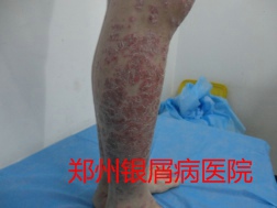 郑州牛皮癣医院治疗牛皮癣图片