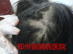郑州牛皮癣医院治疗牛皮癣图片