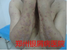 郑州牛皮癣医院治疗牛皮癣图片