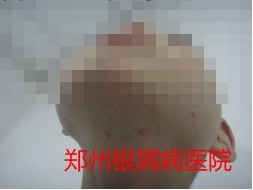 郑州牛皮癣医院治疗牛皮癣图片