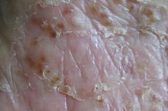 寻常型牛皮癣都有哪些临床症状