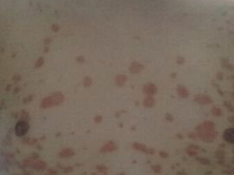 关节病型银屑病的危害是什么