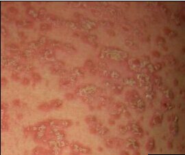 脓疱型银屑病一般都是怎么治