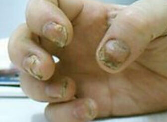 银屑病患者饮食需要注意哪些问题