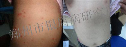 郑州银屑病研究所